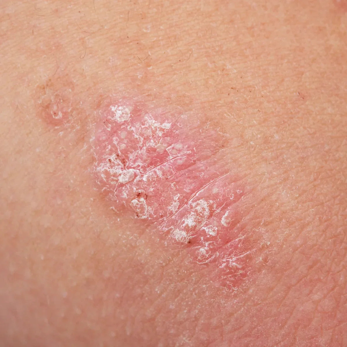 Say Goodbye to Psoriasis: The Best 3 Remedies Revealed